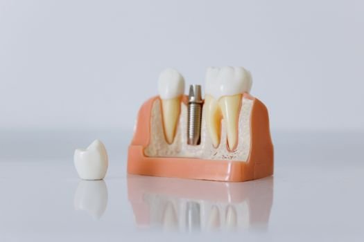 How Much Do Dental Implants Cost in Virginia? A Plain-English Breakdown for Crozet Patients